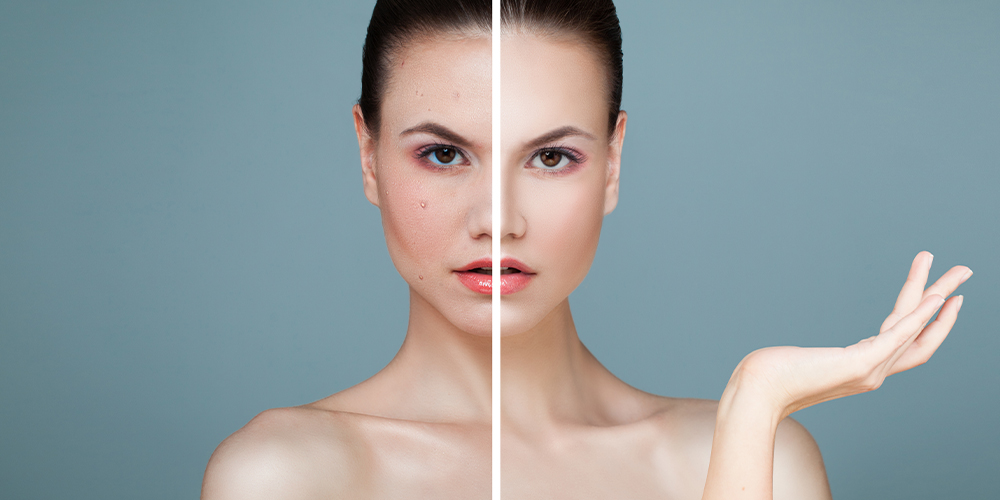 Cilt Yenileme ve Leke Tedavisi